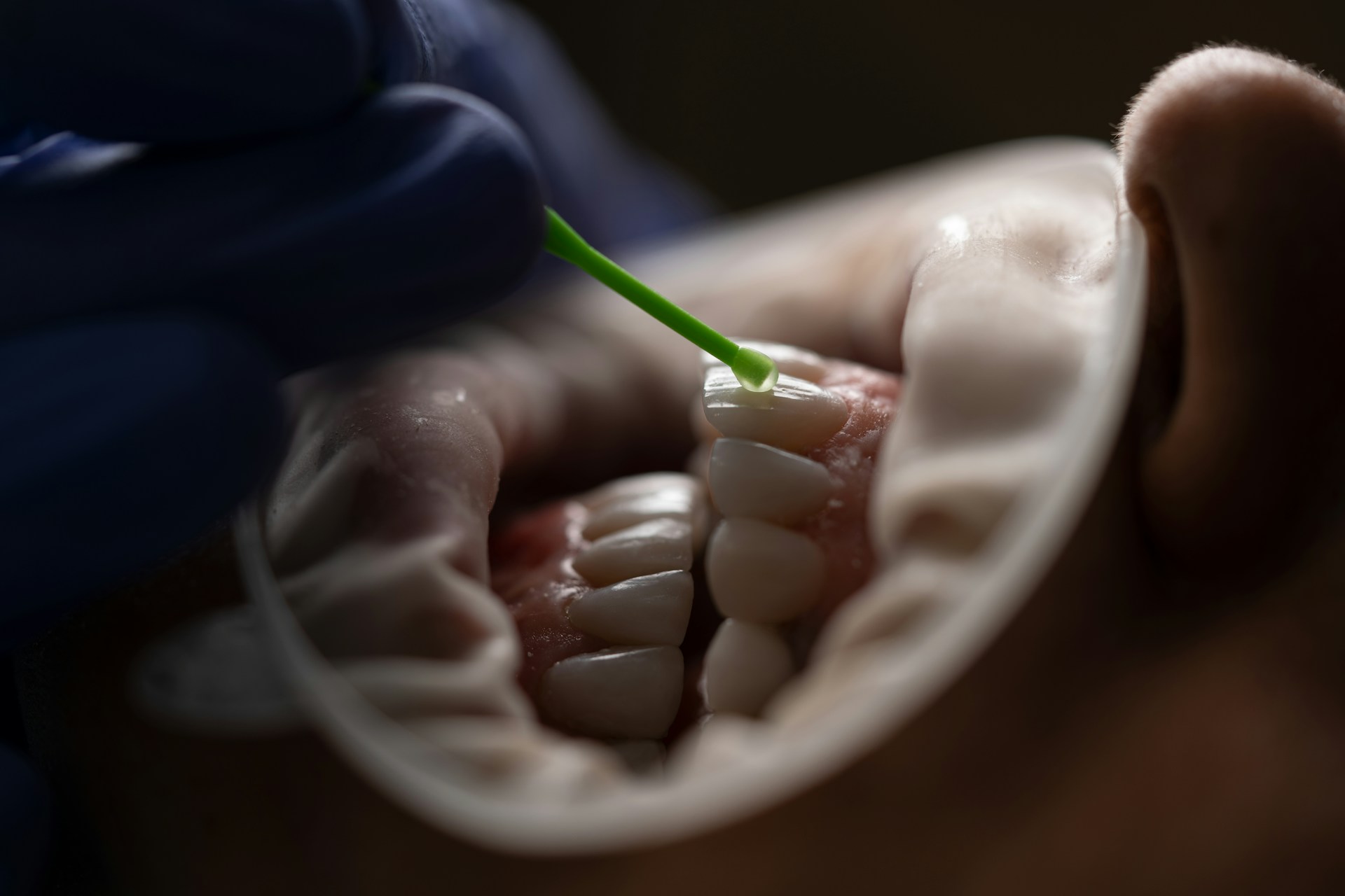 The Costs of Veneers: Breaking Down the Investment