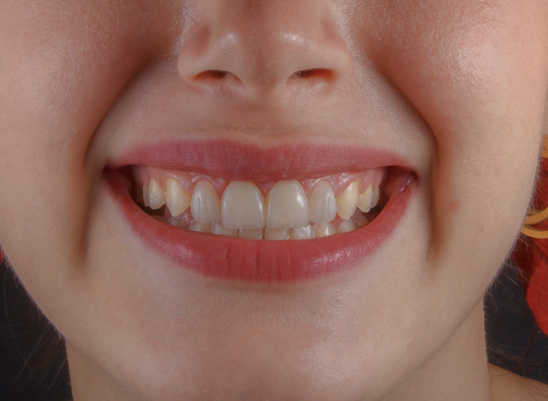 How Long Does Dental Bonding Last