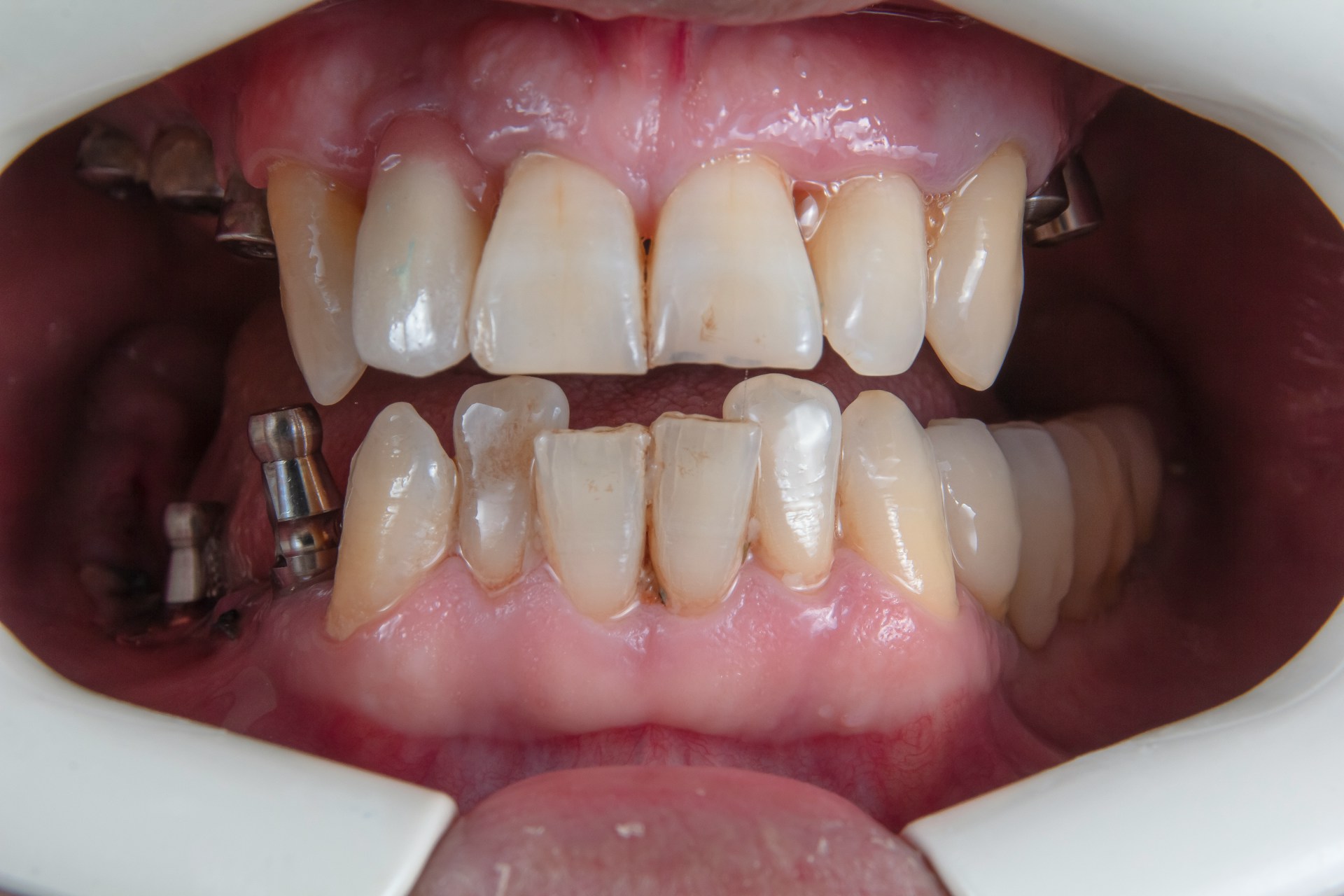 Dental Bonding for Crooked Teeth