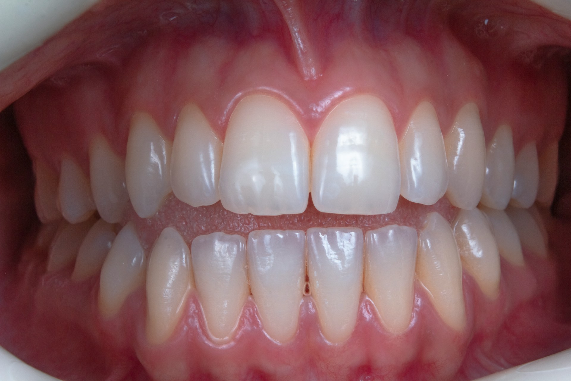 What Is Gum Contouring